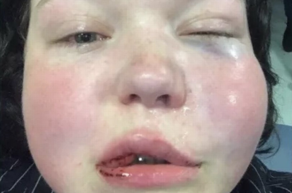 Image of Robyn after Dublin assault